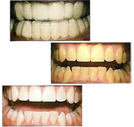 домашнее отбеливание зубов: до и после