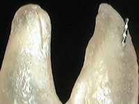 Возникновения перфорации корня зуба