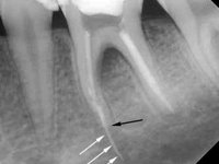 Вывод гуттаперчи за верхушку зуба