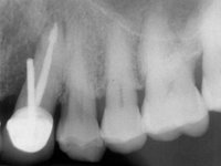 Перфорация корня зуба, допущенная при установке штифта фото 2