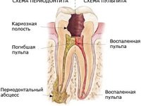 Схема развития пульпита и периодонтита Схема развития пульпита и периодонтита