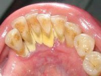 Твердые зубные отложения на внутренней поверхности зубов