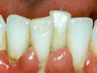 Твердые и мягкие зубные отложения в районе шеек зубов фото