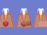 Резекция корня зуба при гранулеме