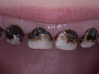 Зубы после серебрения фото