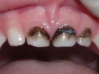 Вид зубов после серебрения фото
