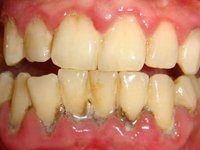 Обильные отложения зубного камня в области нижних зубов фото