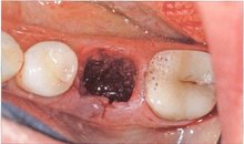 Кровяной сгусток в лунке удаленного зуба спустя несколько дней после удаления