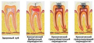 Формы периодонтита зуба фото