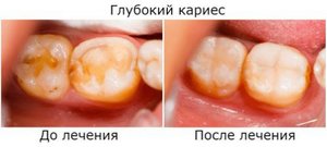 Глубокий кариес до/после фото Глубокий кариес до/после фото