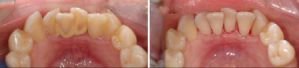 Удаление зубных отложений при помощи ультразвука фото