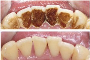 Снятие зубных отложений ультразвуком фото до и после