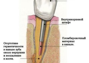 Развитие хронического периодонтита у зуба под коронкой