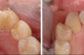 Фото до и после удаления зубного камня